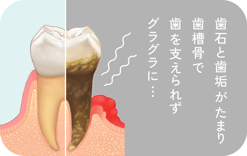 歯石と歯垢がたまり、歯槽骨で歯を支えられず、グラグラに…